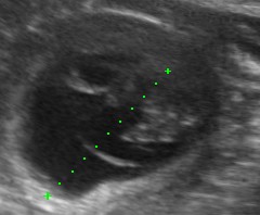 14977-_Bubbly_20150827_Abdomen_0001