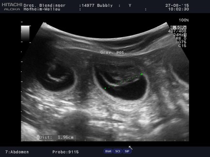 14977-_Bubbly_20150827_Abdomen_0004